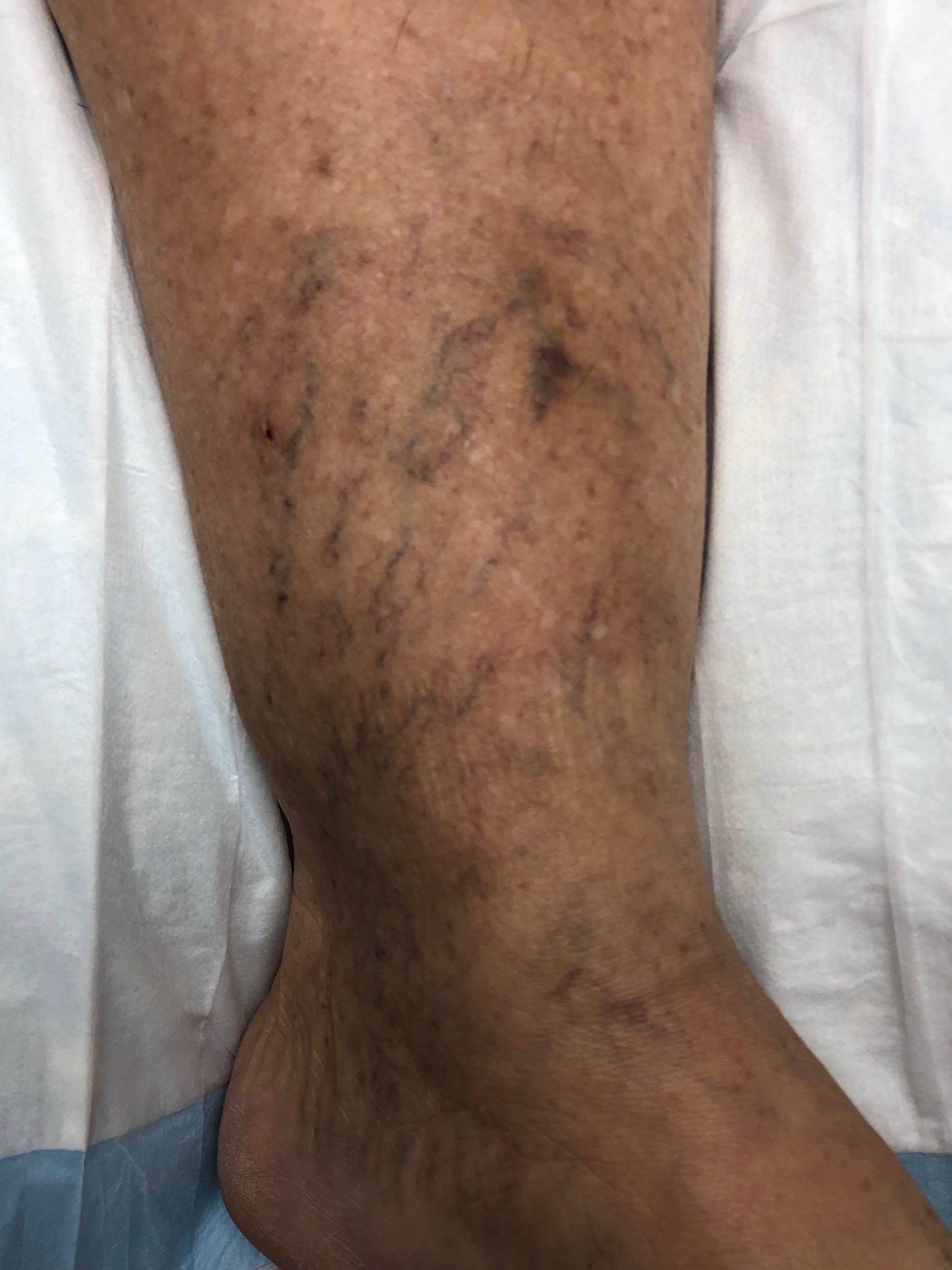 THE TYPES OF STAINING THAT MAY OCCUR AFTER SCLEROTHERAPY | Vein Therapy ...